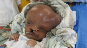 hydrocephalas